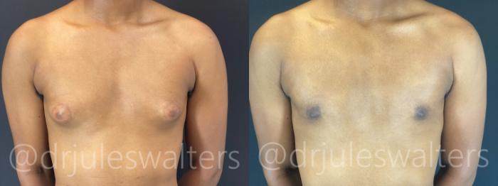 Before & After Gynecomastia Case 175 Front View in Metairie and New Orleans, LA