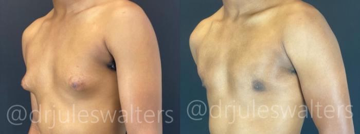 Before & After Gynecomastia Case 175 Left Oblique View in Metairie and New Orleans, LA