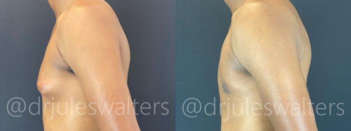 Before & After Gynecomastia Case 175 Left Side View in Metairie and New Orleans, LA