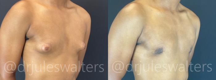 Before & After Gynecomastia Case 175 Right Oblique View in Metairie and New Orleans, LA