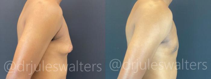 Before & After Gynecomastia Case 175 Right Side View in Metairie and New Orleans, LA