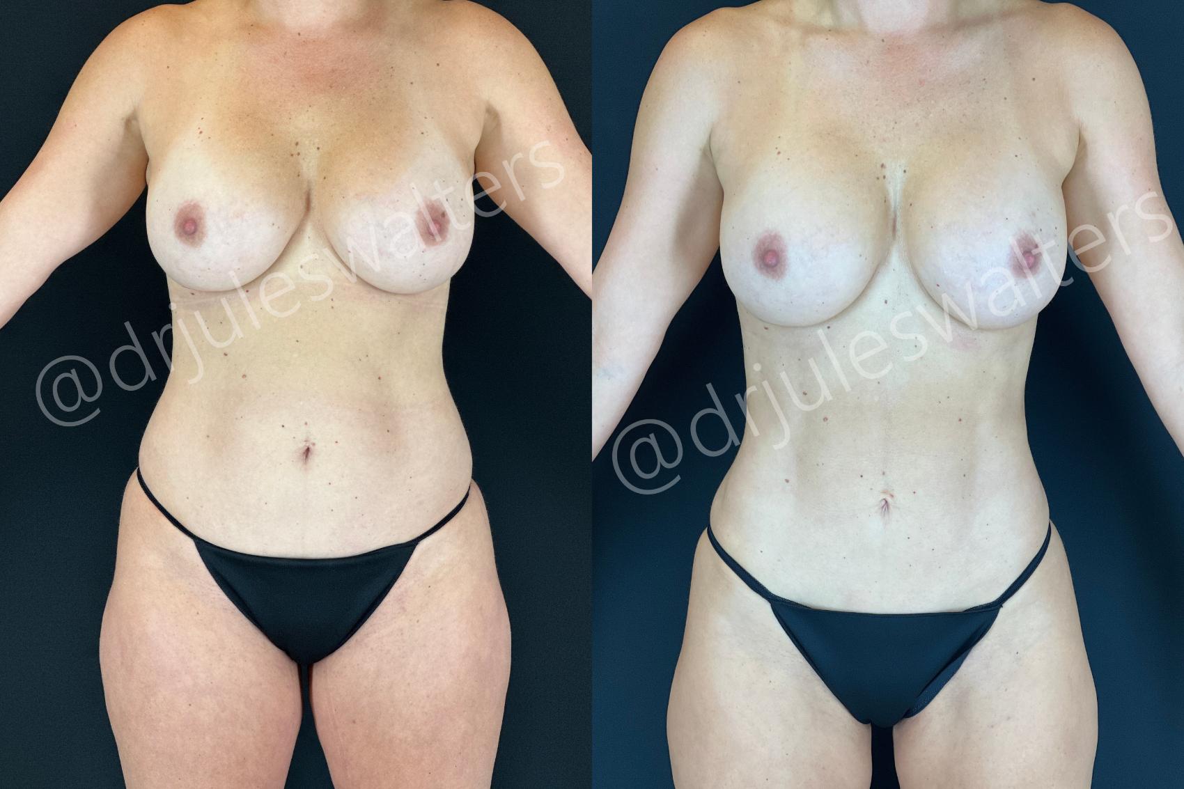 Before & After Hi-Definition Liposuction Case 186 Front View in Metairie and New Orleans, LA
