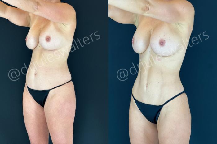 Before & After Hi-Definition Liposuction Case 186 Left Oblique View in Metairie and New Orleans, LA
