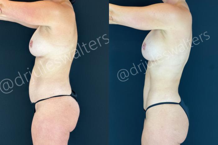 Before & After Hi-Definition Liposuction Case 186 Left Side View in Metairie and New Orleans, LA