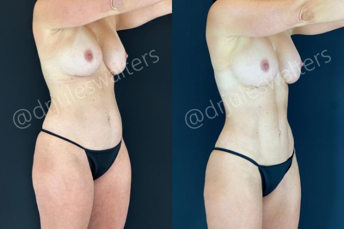 Before & After Hi-Definition Liposuction Case 186 Right Oblique View in Metairie and New Orleans, LA