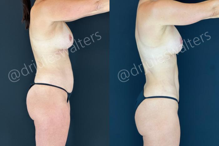 Before & After Hi-Definition Liposuction Case 186 Right Side View in Metairie and New Orleans, LA