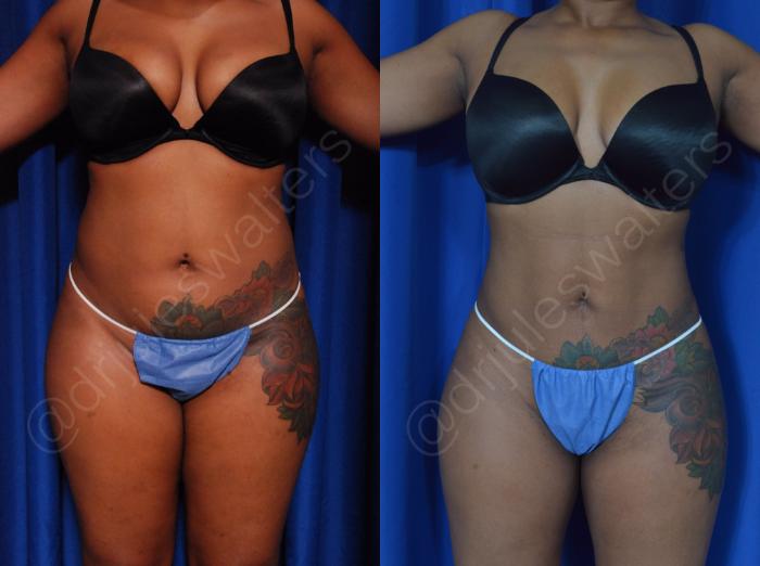 Before & After Liposuction Case 42 View #1 View in Metairie and New Orleans, LA