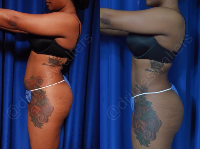Before & After Liposuction Case 42 View #2 View in Metairie and New Orleans, LA