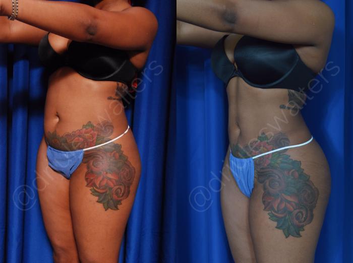 Before & After Hi-Definition Liposuction Case 42 View #3 View in Metairie and New Orleans, LA