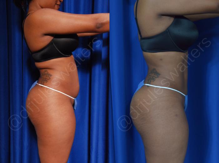 Before & After Liposuction Case 42 View #4 View in Metairie and New Orleans, LA