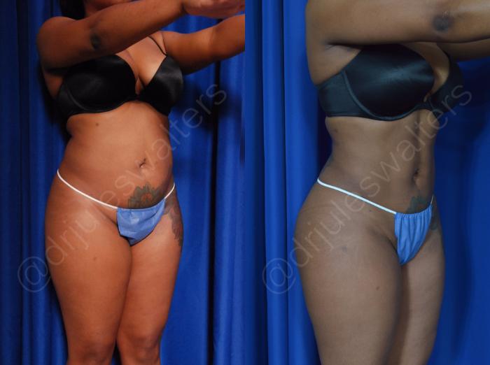 Before & After Liposuction Case 42 View #5 View in Metairie and New Orleans, LA