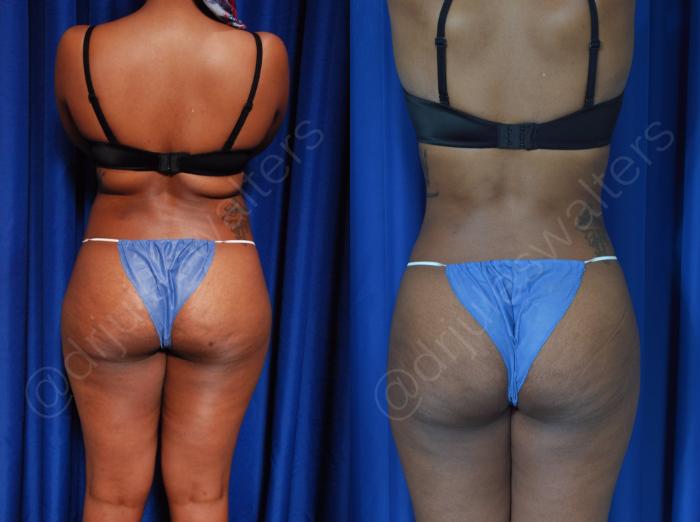 Before & After Hi-Definition Liposuction Case 42 View #6 View in Metairie and New Orleans, LA