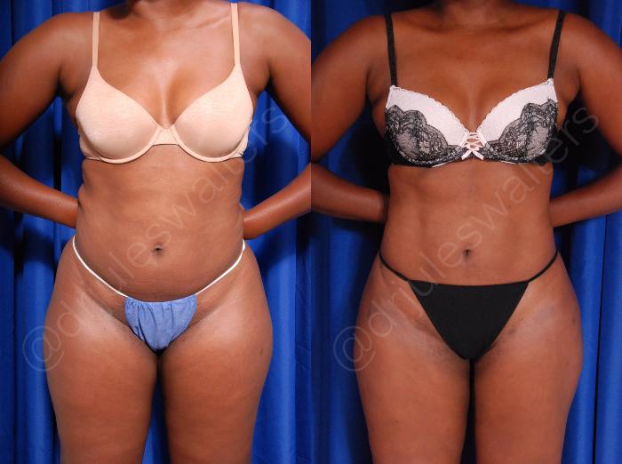 Before & After Hi-Definition Liposuction Case 43 View #1 View in Metairie and New Orleans, LA