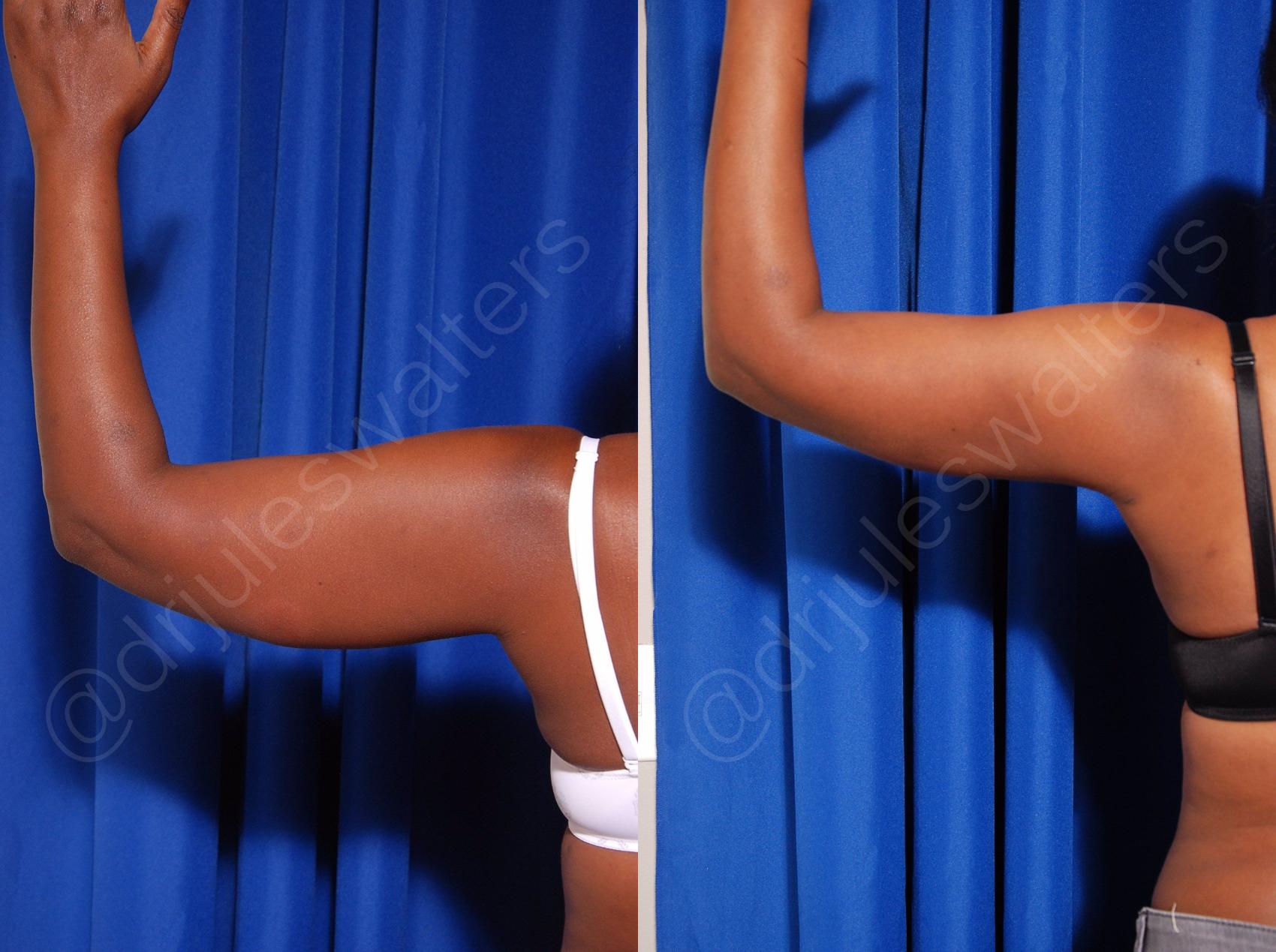 Before & After Hi-Definition Liposuction Case 43 View #2 View in Metairie and New Orleans, LA