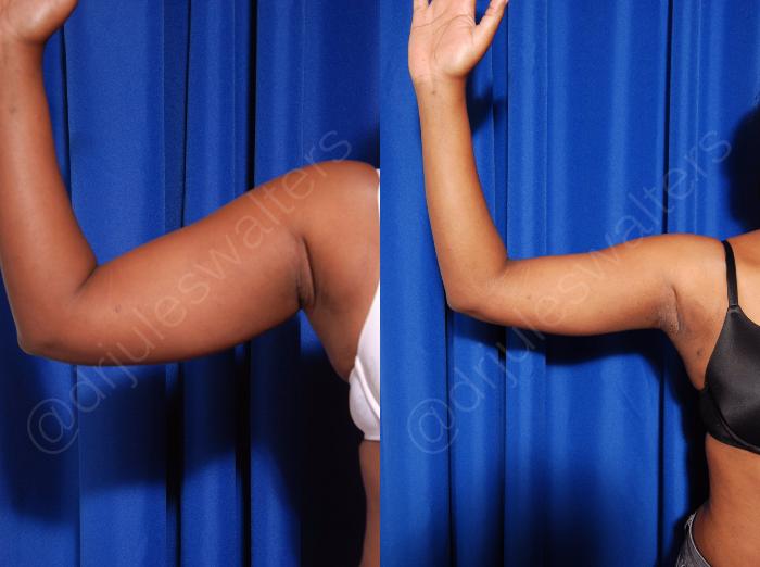 Before & After Body Contouring Case 43 View #5 View in Metairie and New Orleans, LA