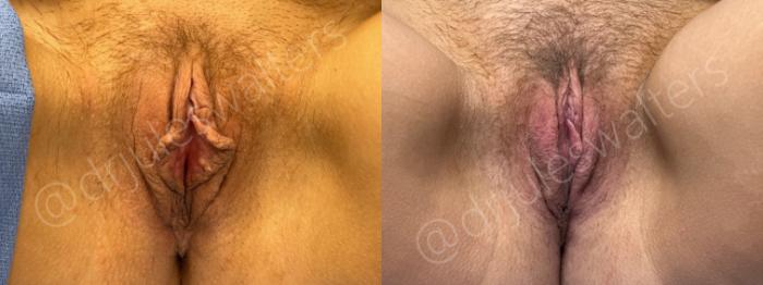Before & After Labiaplasty Case 148 Front View in Metairie and New Orleans, LA