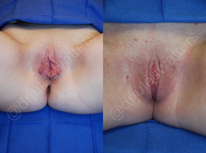 Before & After Labiaplasty Case 32 View #1 View in Metairie and New Orleans, LA