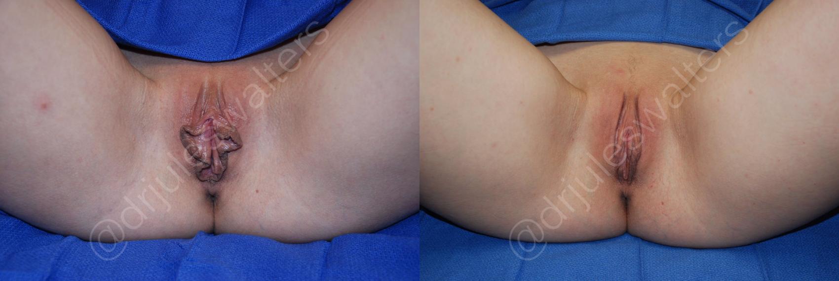 Before & After Labiaplasty Case 33 View #1 View in Metairie, New Orleans, Covington, LA