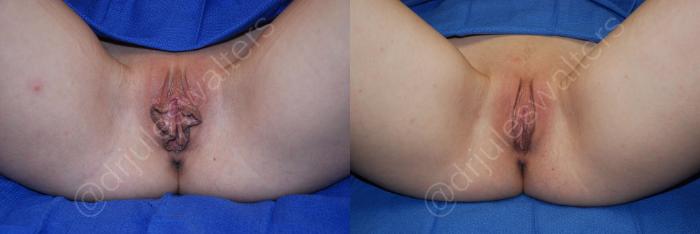 Before & After Labiaplasty Case 33 View #1 View in Metairie and New Orleans, LA
