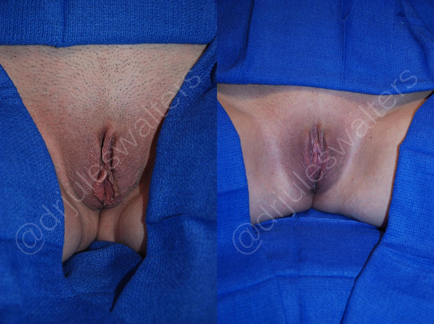Before & After Labiaplasty Case 37 View #1 View in Metairie and New Orleans, LA