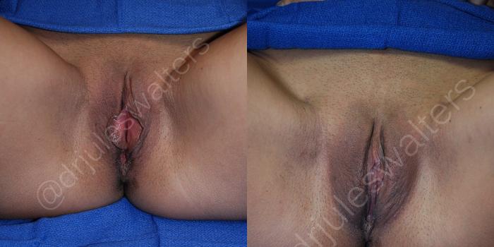 Before & After Labiaplasty Case 40 View #1 View in Metairie and New Orleans, LA