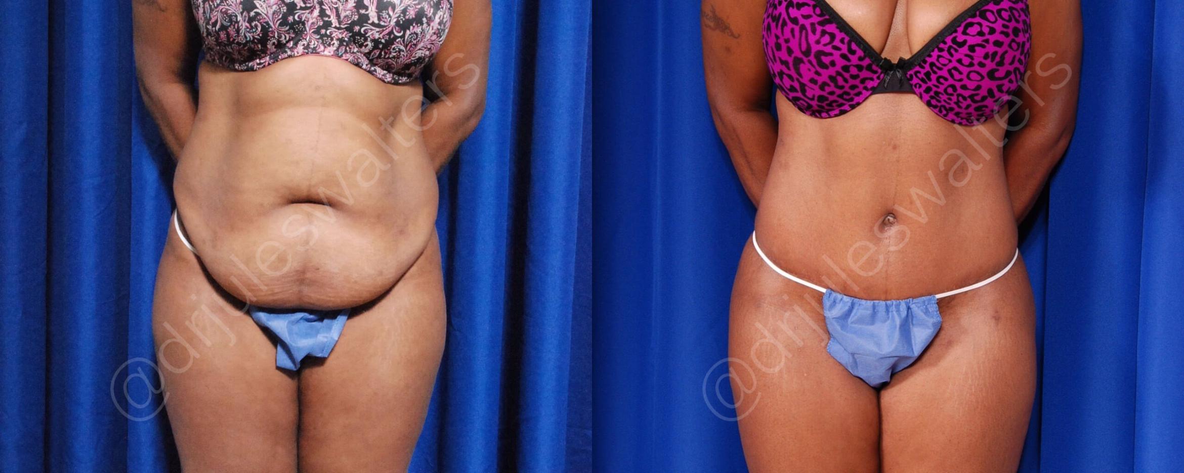 Before & After Liposuction Case 45 View #1 View in Metairie, New Orleans, Covington, LA