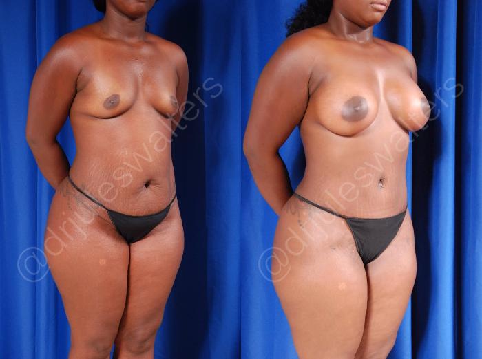 Before & After Liposuction Case 1 View #4 View in Metairie and New Orleans, LA