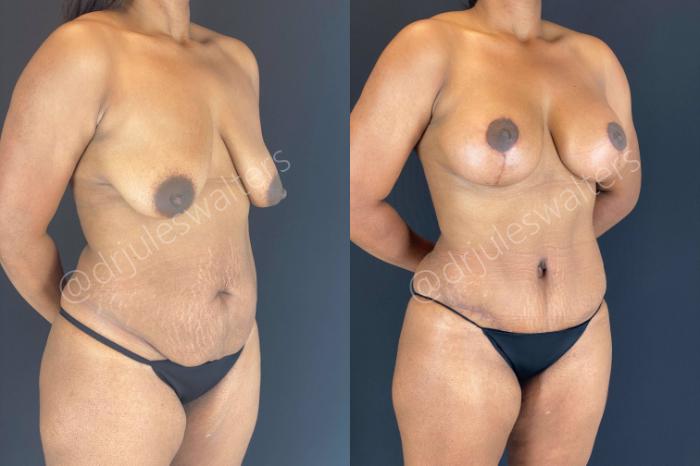 Before & After Liposuction Case 110 View #1 View in Metairie and New Orleans, LA