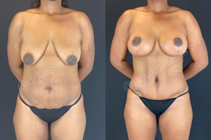 Before & After Liposuction Case 110 View #2 View in Metairie and New Orleans, LA