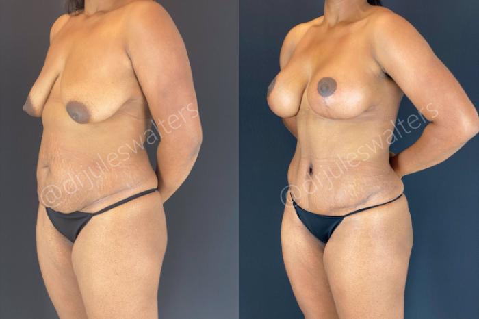 Before & After Tummy Tuck Case 110 View #3 View in Metairie and New Orleans, LA