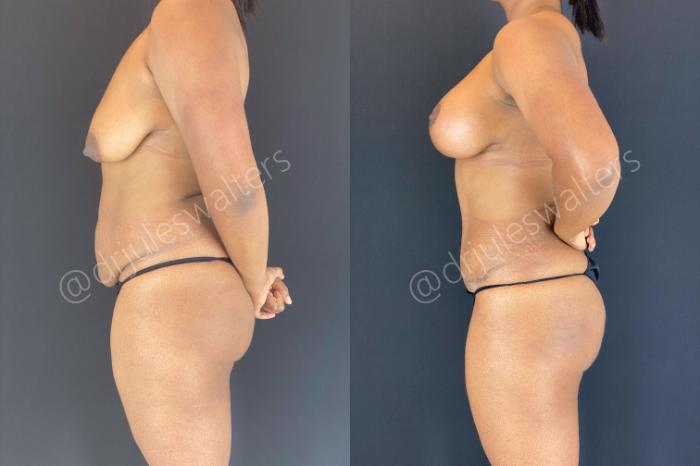 Before & After Breast Augmentation + Lift Case 110 View #4 View in Metairie and New Orleans, LA