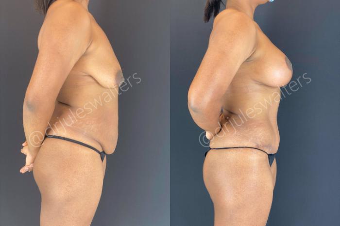 Before & After Breast Augmentation + Lift Case 110 View #6 View in Metairie and New Orleans, LA