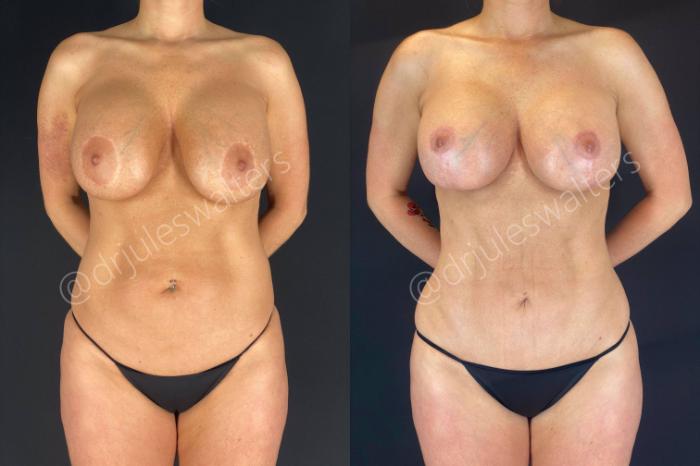Before & After Body Contouring Case 15 View #2 View in Metairie and New Orleans, LA