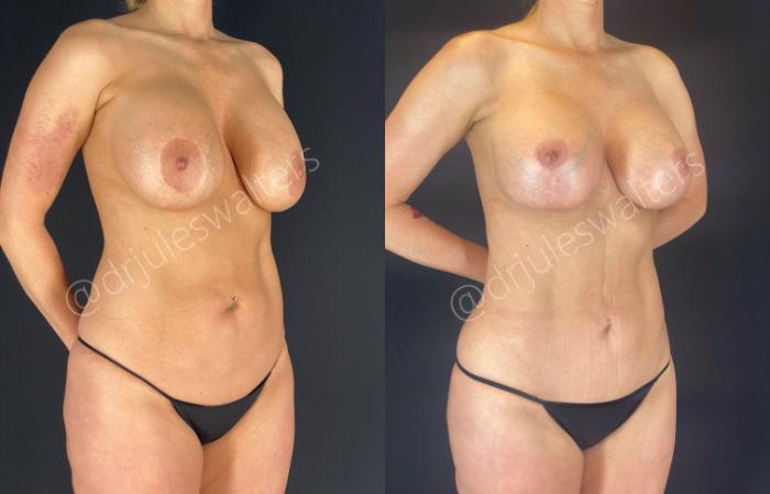Before & After Breast Revision Case 15 View #4 View in Metairie and New Orleans, LA