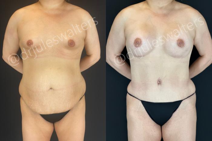 Before & After Tummy Tuck Case 166 Front View in Metairie and New Orleans, LA