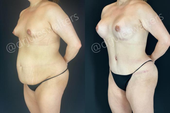 Before & After Tummy Tuck Case 166 Left Oblique View in Metairie and New Orleans, LA