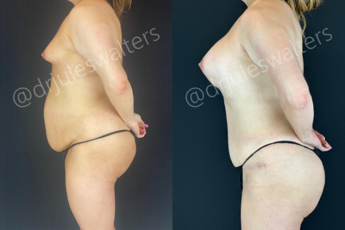 Before & After Tummy Tuck Case 166 Left Side View in Metairie and New Orleans, LA