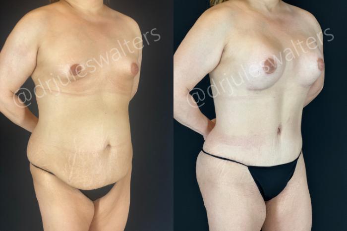 Before & After Tummy Tuck Case 166 Right Oblique View in Metairie and New Orleans, LA