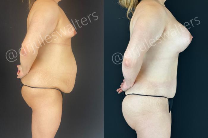 Before & After Tummy Tuck Case 166 Right Side View in Metairie and New Orleans, LA