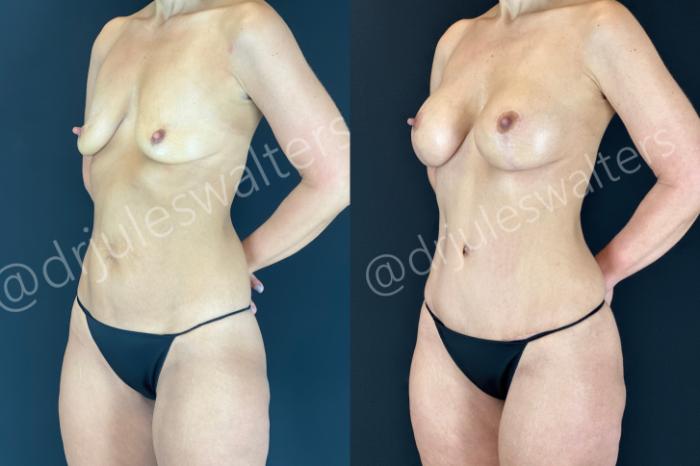 Before & After Mommy Makeover Case 174 Left Oblique View in Metairie and New Orleans, LA