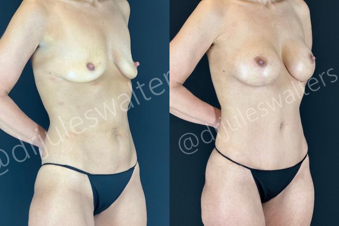 Before & After Mommy Makeover Case 174 Right Oblique View in Metairie and New Orleans, LA