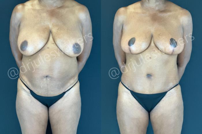 Before & After Tummy Tuck Case 176 Front View in Metairie and New Orleans, LA