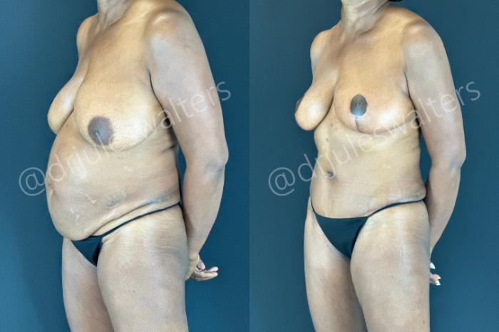 Before & After Mommy Makeover Case 176 Left Oblique View in Metairie and New Orleans, LA