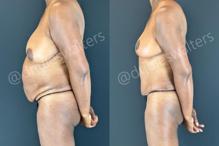 Before & After Tummy Tuck Case 176 Left Side View in Metairie and New Orleans, LA