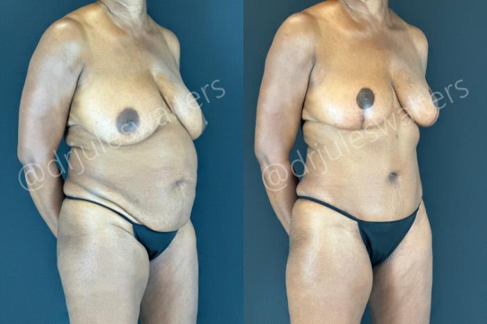 Before & After Tummy Tuck Case 176 Right Oblique View in Metairie and New Orleans, LA