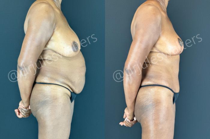 Before & After Tummy Tuck Case 176 Right Side View in Metairie and New Orleans, LA