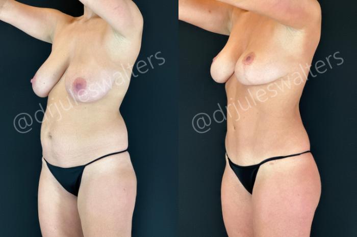 Before & After Liposuction Case 184 Left Oblique View in Metairie and New Orleans, LA