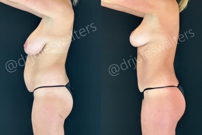 Before & After Liposuction Case 184 Left Side View in Metairie and New Orleans, LA