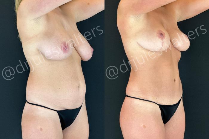 Before & After Breast Reduction Case 184 Right Oblique View in Metairie and New Orleans, LA