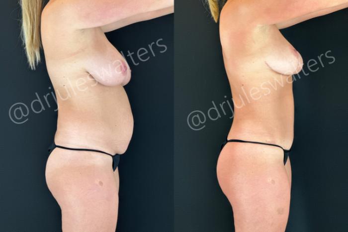 Before & After Tummy Tuck Case 184 Right Side View in Metairie and New Orleans, LA